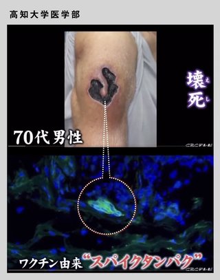 高知大学医学部 > 毒ワクチンの血栓、皮膚壊死