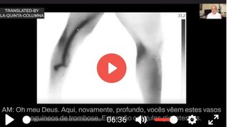 このワクチン接種者の脚の太い血管（黒い部分）にかなりの長さの血栓ができています