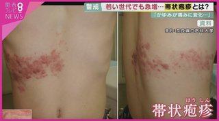 20代 ~ 40代の『帯状疱疹』が急増「ワクチン接種後に発症した」との訴えが殺到