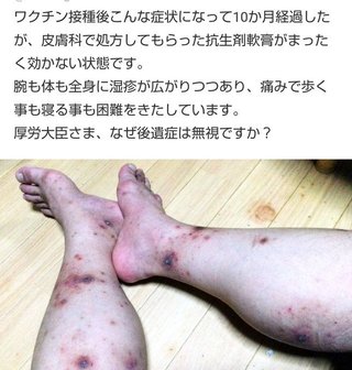 ワクチン打って後遺症  
