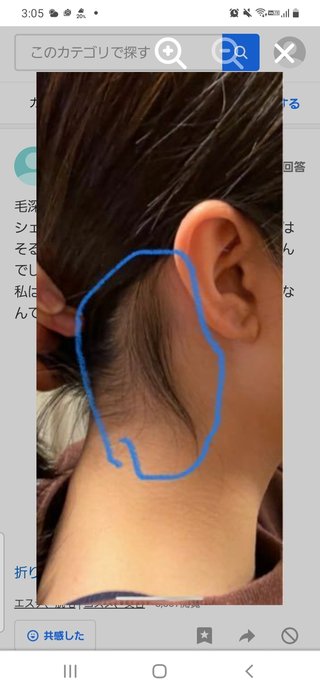 うなじ医療脱毛した人いる？