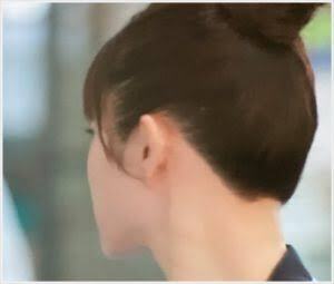 うなじ医療脱毛した人いる？