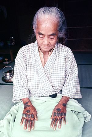 琉球の入れ墨「ハジチ」復興、自らの手で　うちなー女性の誇り刻む