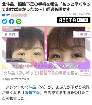 北斗晶、眼瞼下垂の手術したって