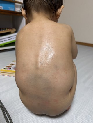 突発性発疹？あせも？