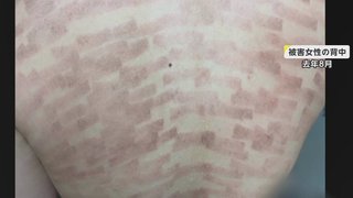 一回2000円“無資格脱毛”でやけど…「ドレス着たいのに」