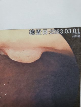 胃カメラポリープ発見