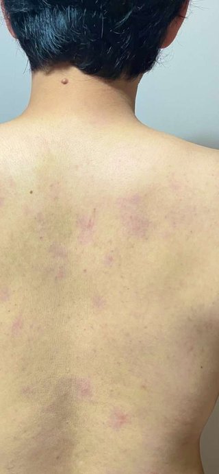 宮下草薙・宮下、愛車テスラをひょうから守る 背中が傷だらけに「考える前に体が動いていました」