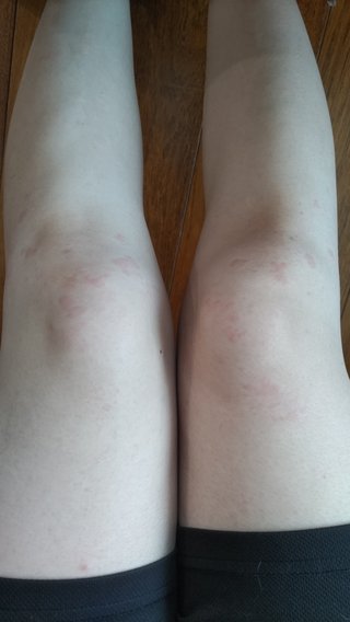 きったない脚ごめん、この虫刺され、なんだと思う？