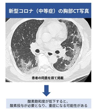 コロナは、ワクチン接種でウイルス肺炎を回避！