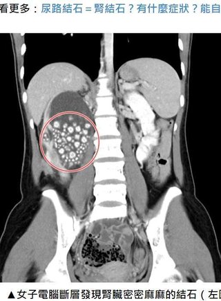 グロ注意「水をほとんど飲まなかった20歳女性の腎臓から300個以上の結石を回収（台湾）