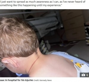 添い寝の母親の髪が首に巻き付いた1歳児、呼吸が止まり首に紫の痕残る（豪）