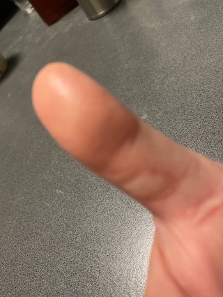 火傷で水ぶくれ