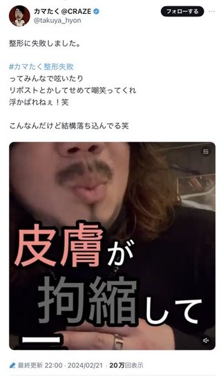 人気インフルエンサー・カマたく　200万円の鼻整形も、失敗を報告「感染症を引き起こし」