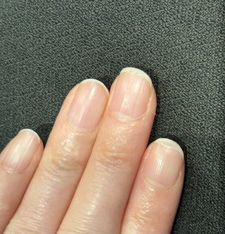 二枚爪を治したい