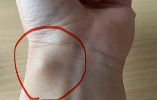 手首にしこりできてる