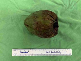 尻にヤシの実挿入 台湾人男性 排尿できず病院受診 医師「刺激求める時は慎重に」