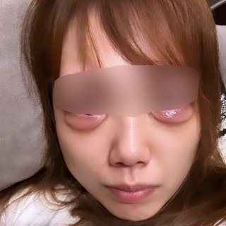 【グロ注意】涙袋をつくるためのヒアルロン酸注入で“デメキン”に…大手美容クリニックAで施術