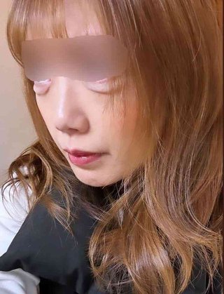 【グロ注意】涙袋をつくるためのヒアルロン酸注入で“デメキン”に…大手美容クリニックAで施術