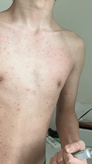 グロ画注意！１４歳の子供の湿疹