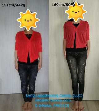 身長を18cm“買った”55歳女性。2100万円かけて海外で「骨延長」手術したワケ