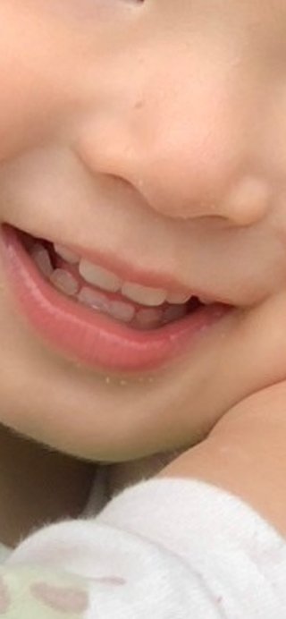 2歳の娘の歯並びなんですが、これって出っ歯ですか？