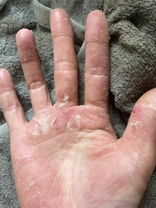 流石にヤバい　痒い