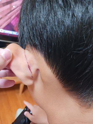 美容師の方に聞きたい。バリカンで耳に当たってこんな傷になることある？