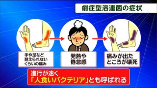 致死率30％の“劇症型溶連菌”　全国で感染拡大