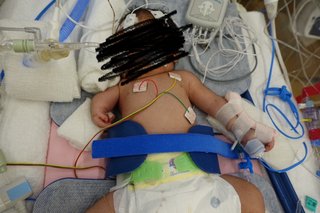 奇形児について教えてください