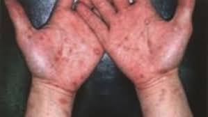 【東京】梅毒感染者2400人超で過去最多ペースで増加…内訳は男性7割女性3割