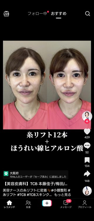 糸リフト１２本