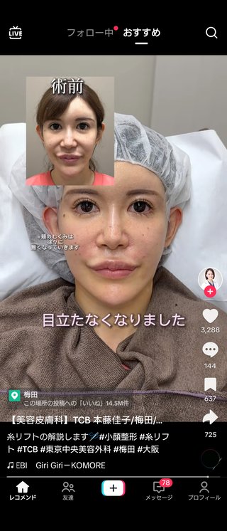 糸リフト１２本