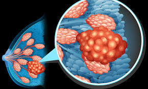 世界トリプルネガティブ乳がん治療市場は2032年までに8億8410万ドルに達する