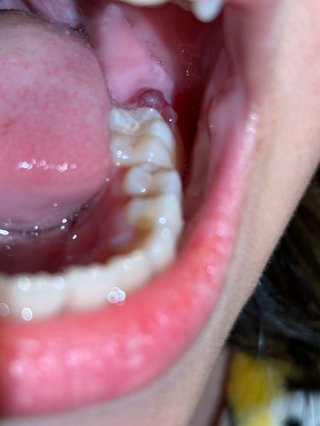 娘の歯茎に出来物。