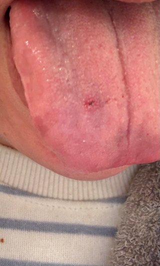 舌が汚い、出来物痛い※汚写真あり