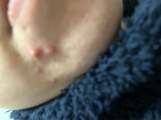 42歳、顎に大きいニキビがずっと出来てて治ら亡くなった