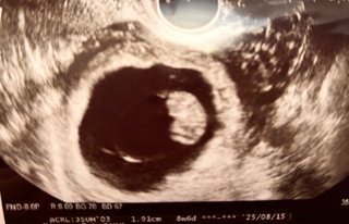 胎芽のサイズについて