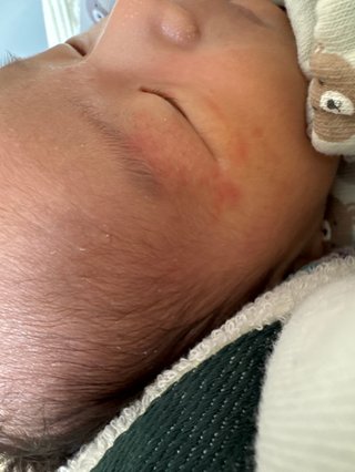 まぶたにニキビのような赤いポツポツ