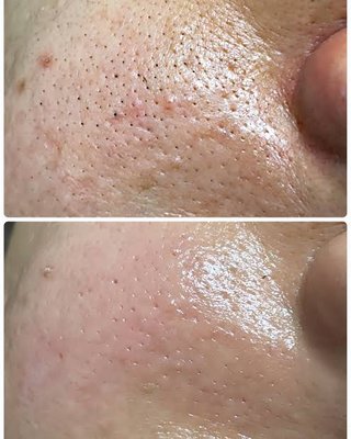 ニキビができやすい人は性欲が強い