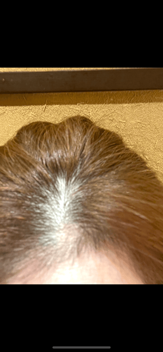 ここって、禿げてるの？？