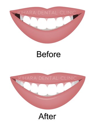 バッカルコリドーって何かやらしくない？