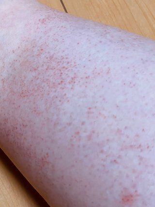 痛くも痒くもないのだけれど、