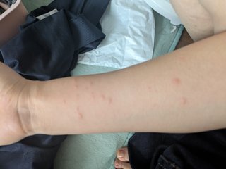 めちゃクソかゆい