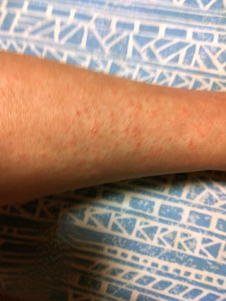 痒い湿疹出た娘