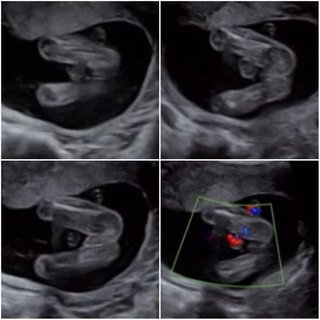 18週 エコー 性別が気になります