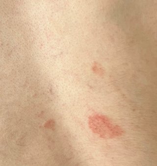 皮膚がんに詳しい方いる？