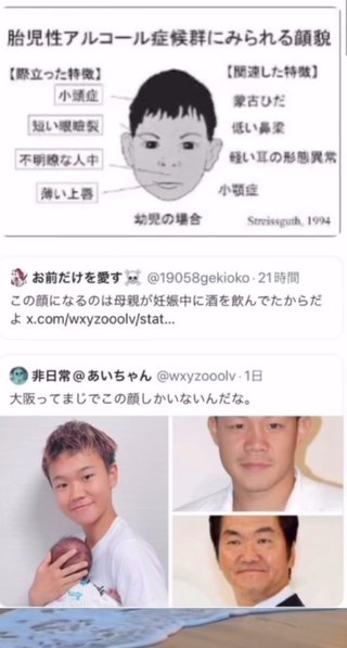 胎児性アルコール症候群の顔特徴