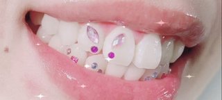 【画像あり】歯科医が警鐘！SNSで流行中の「ティースジュエリー」に潜む落とし穴