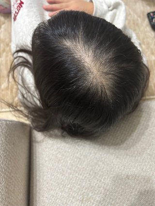 子供の頭皮が不安